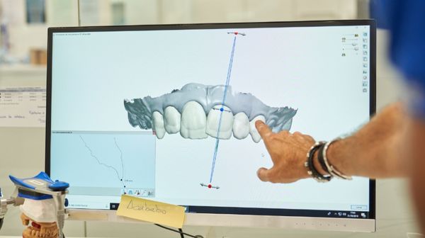 Natural smile design