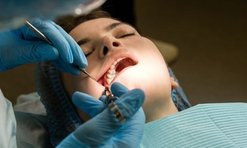 Wisdom Tooth Removal