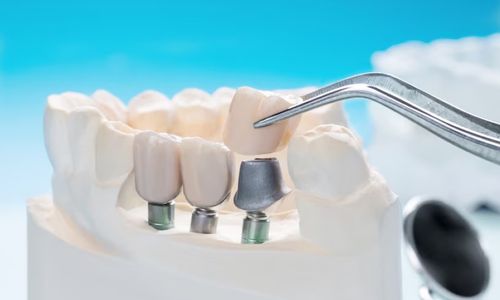 Advanced Implantology