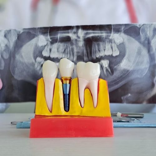 SDAIC - Implantology