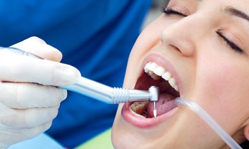 Restorative Fillings & Crowns